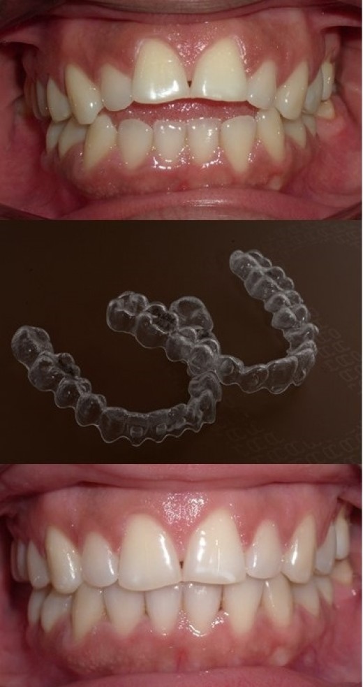 Tratamiento De Malposicion Dental Con Alineadores Transparentes Invisalign