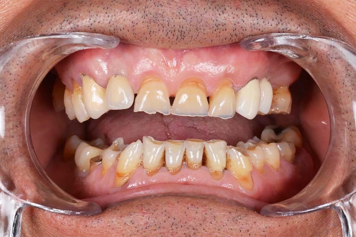 Bruxismo: ¿rechinas los dientes sin darte cuenta?