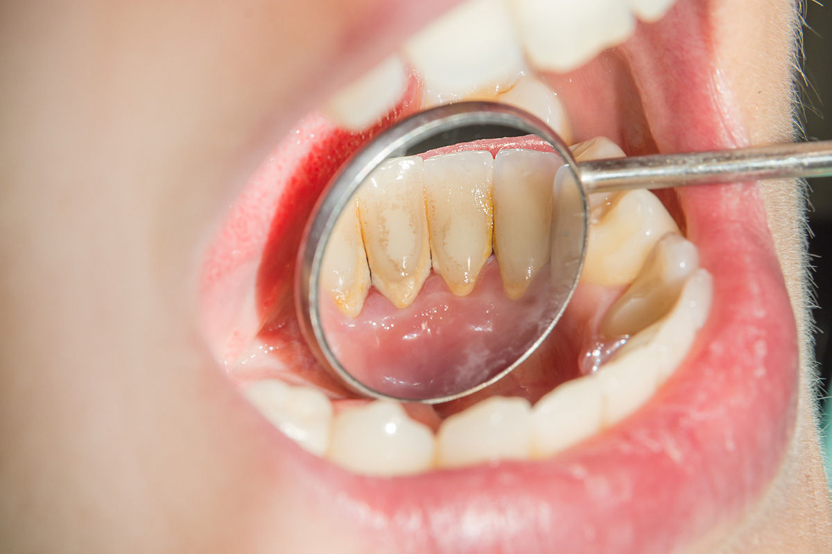 ¿Cómo quitar el sarro de los dientes rápido y fácil?