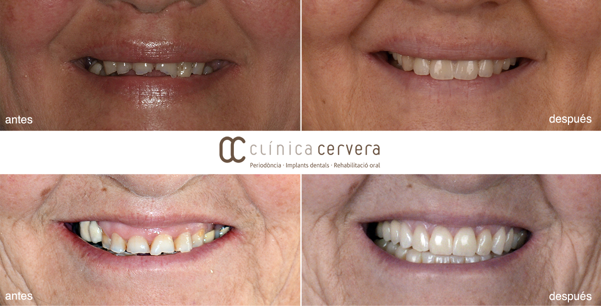 https://www.clinicacervera.es/uploads/slidespages/2_10102017114311_carillas-dentales.jpg